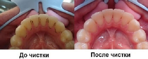 До и после удаления зубного камня