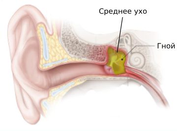 Острый средний отит. Профилактика.